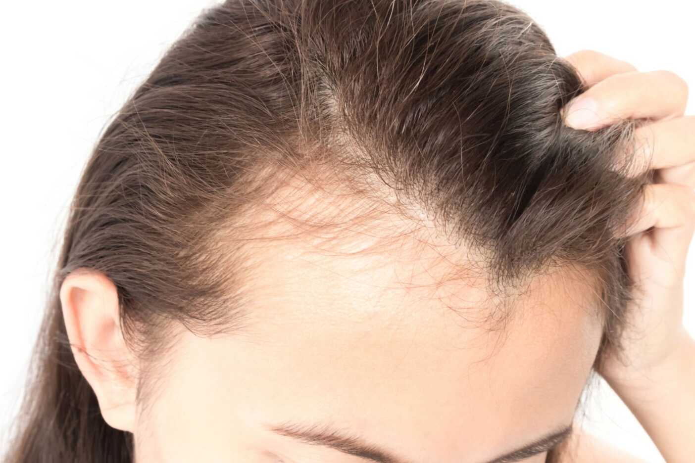 A close-up image of a person with long brown hair, showing the top of their head with noticeable thinning hair. The person is using one hand to lift the hair up, revealing a receding hairline and sparse growth at the front of the scalp. Seeking professional advice from a top-rated hair salon in Cary, NC can help address these concerns.